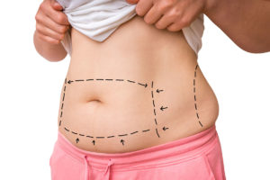 liposuction surgery San Jose, CA - white belly fat with dashed marker lines 