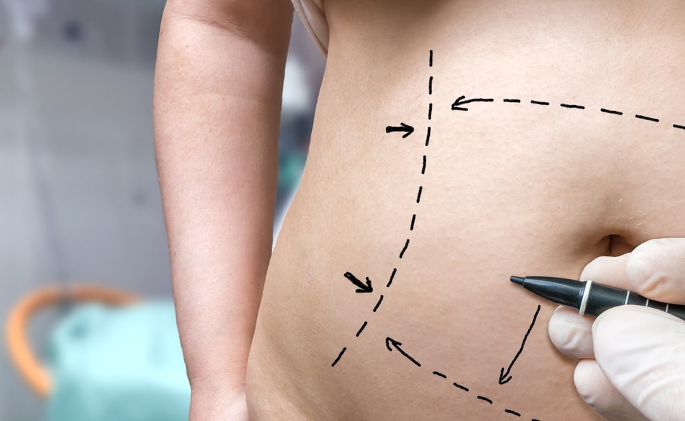 tummy-tuck-Santa-Cruz-CA - Plastic surgery concept. Hand is drawing lines with marker on belly.