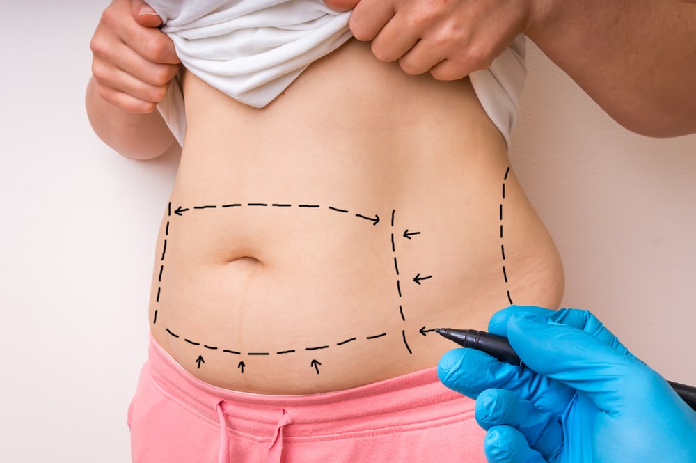 tummy tuck surgery San Jose, CA